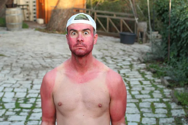 Zonverbrande Jongeman Met Extreme Bruine Lijnen — Stockfoto