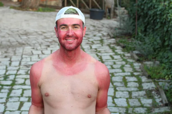 Sonnengebrannter Junger Mann Mit Extremen Bräunungslinien — Stockfoto