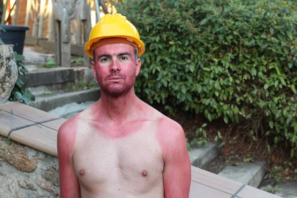 Sunburned young man with extreme tan lines