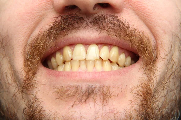 Hombre Blanco Con Barba Bigote Muestra Los Dientes Apretados Parte — Foto de Stock