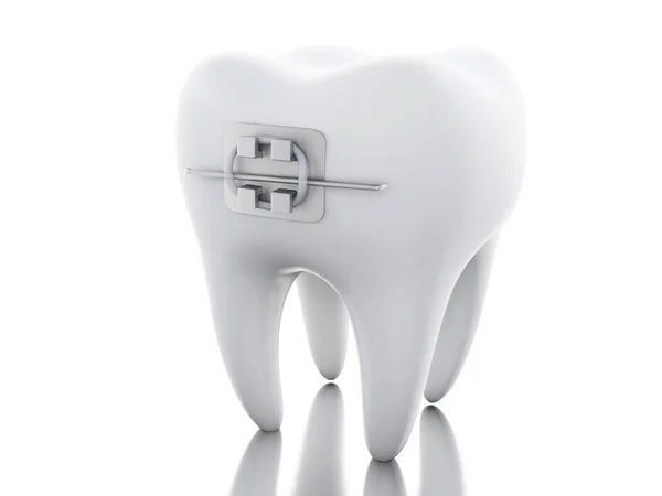 3D Tooth with braces. — Stock Photo, Image