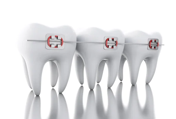 3D Tooth with braces. — Stock Photo, Image