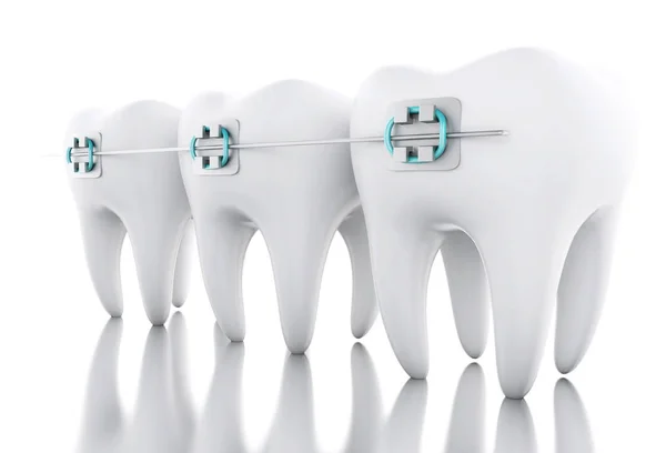 3D Tooth with braces. — Stock Photo, Image