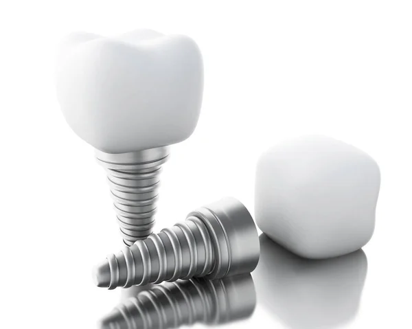 3D dental tand implantaat. — Stockfoto