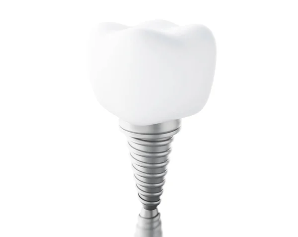 3D Dental tooth implant. — Stock Photo, Image