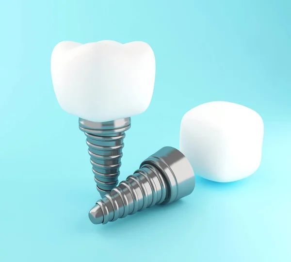 3d Dental tooth implant. — Stock Photo, Image