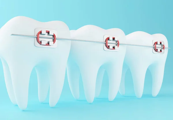 3D Tooth with braces. — Stock Photo, Image