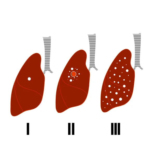 Tuberculosis Lesion Stages Konsep Pelayanan Dan Perawatan Kesehatan Ilustrasi Vektor - Stok Vektor