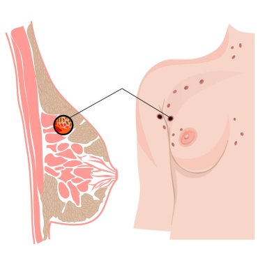 Göğüs kanseri belirtileri. Kadın Sağlığı Konsepti. Vektör İllüstrasyonu