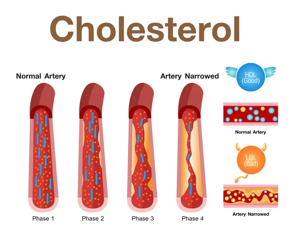 Colesterol Artéria Desenho Vetorial — Vetor de Stock