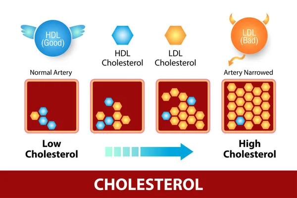 Colesterol Artéria Risco Para Saúde — Vetor de Stock