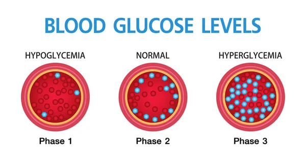 Hyperglykemi Högt Blodsocker Och Diabetes Fetma Ett Allvarligt Medicinskt Tillstånd — Stock vektor