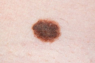 İnsan derisinde büyük kahverengi bir ben var. Dermatoloji önleme mol kadın cilt doktoru.