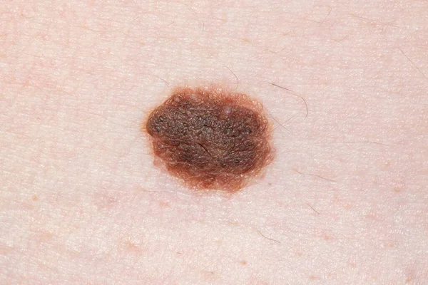 Grande taupe brune sur la peau humaine. Dermatologie prévention taupes femme peau médecin . — Photo