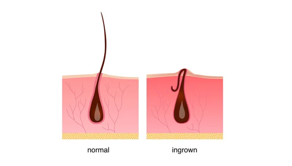 Eingewachsene Haare nach der Rasur, Creme oder Epilator. Anatomie-Infografik — Stockvektor