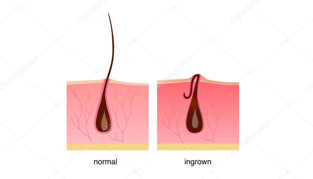 Ingrown hair after shaving, cream or epilator. Anatomy infographics