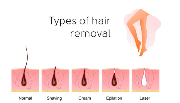 Comparação dos métodos populares de remoção de cabelo : — Vetor de Stock