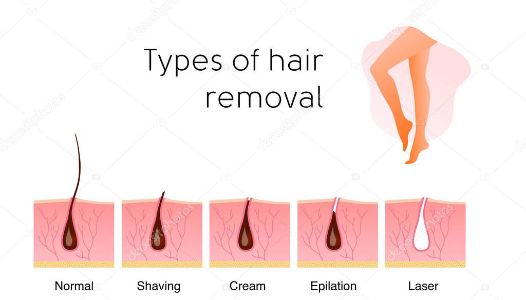 Comparison of the popular methods of hair removal: