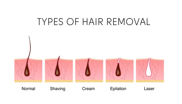 Comparison of the popular methods of hair removal: shaving, cream, epilator, and laser. — ストックベクタ