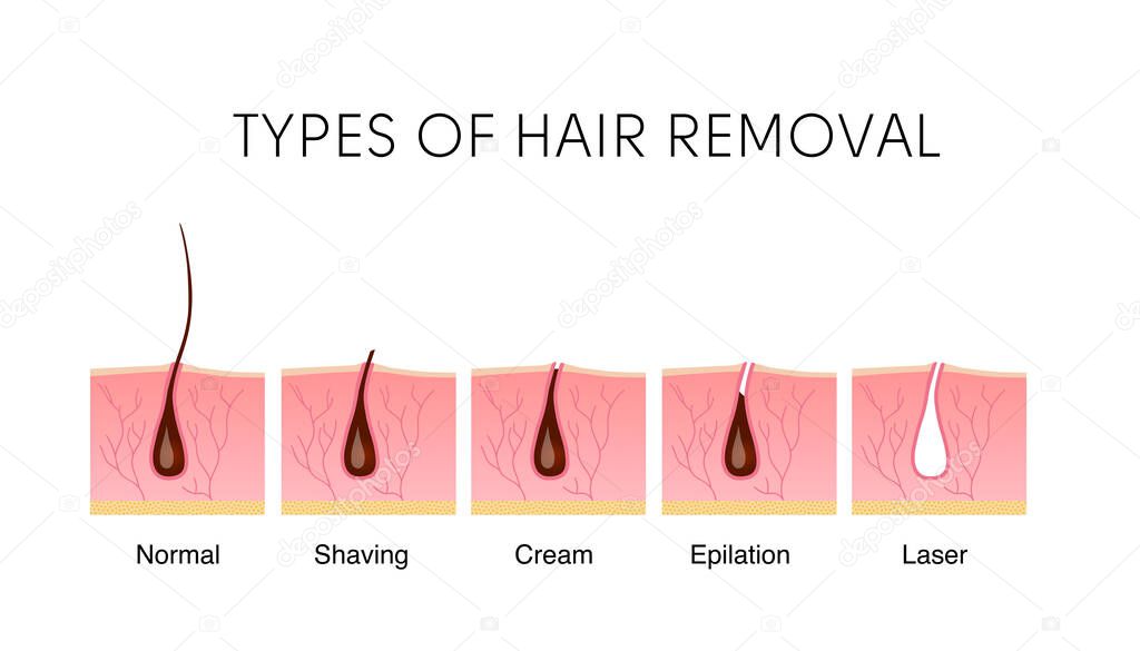 Comparison of the popular methods of hair removal: shaving, cream, epilator, and laser. 
