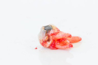 Beyaz arka plan üzerinde çürük diş çıkarma. 