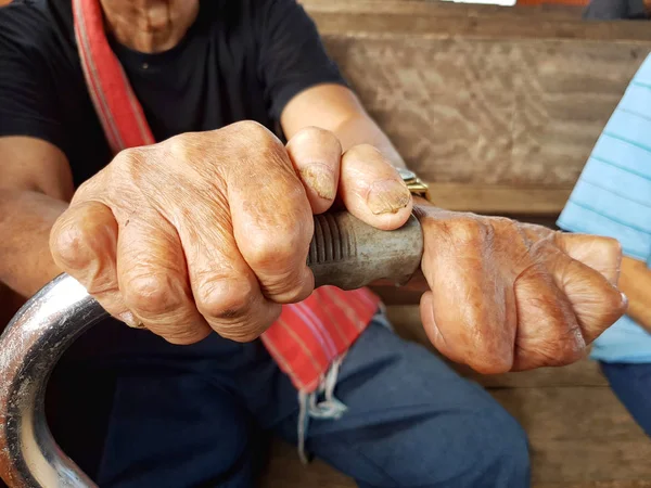 亚洲老人拿着甘蔗患有麻风病的特写镜头手, 泰国 — 图库照片