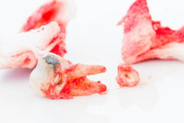 Beyaz arka plan üzerinde kanlı gazlı bez paneliyle çürük diş çıkarma. Sağlık kavramı