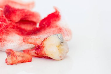 Beyaz arka plan üzerinde kanlı gazlı bez paneliyle çürük diş çıkarma. Sağlık kavramı