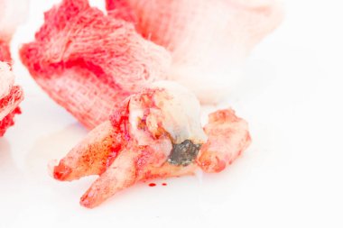 Beyaz arka plan üzerinde kanlı gazlı bez paneliyle çürük diş çıkarma. Sağlık kavramı