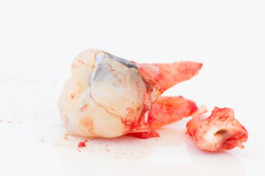 Beyaz arka plan üzerinde çürük diş çıkarma. 