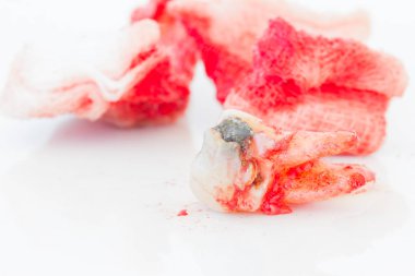 Beyaz arka plan üzerinde kanlı gazlı bez paneliyle çürük diş çıkarma. Sağlık kavramı