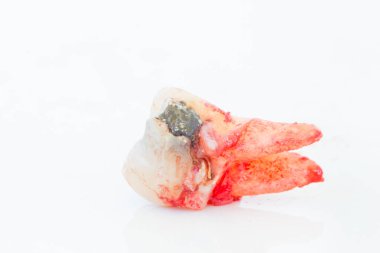 Beyaz arka plan üzerinde çürük diş çıkarma. 