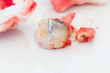 Beyaz arka plan üzerinde kanlı gazlı bez paneliyle çürük diş çıkarma. Sağlık kavramı