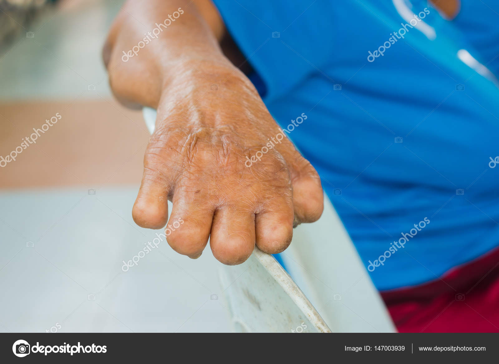Vértes kéz-régi ázsiai nő szenved a lepra, amputált kéz — Stock Fotó