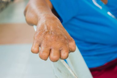 cüzzam, uzvunu el acı eski Asyalı kadın portre el