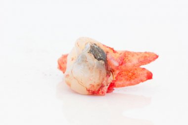 Beyaz arka plan üzerinde çürük diş çıkarma. 