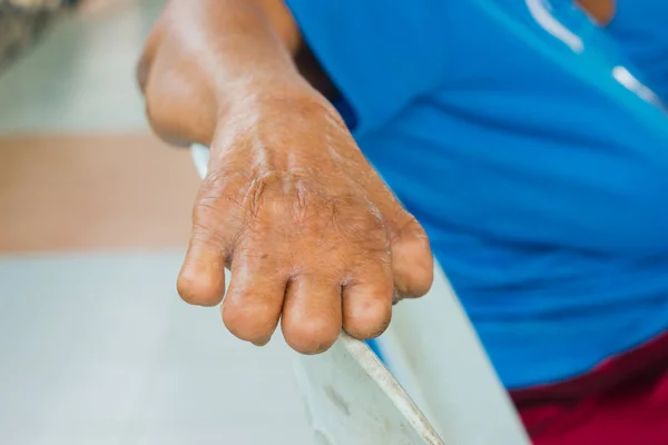 Primer plano mano de viejo asiático mujer sufriendo de lepra, amputado mano — Foto de Stock