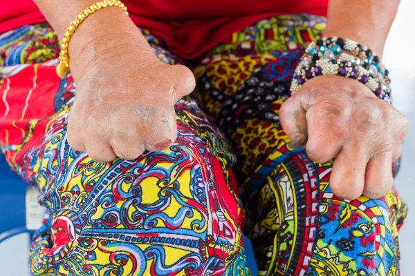 Primer plano femenino asiático manos de viejo mujer sufriendo de lepra amputado manos . — Foto de Stock