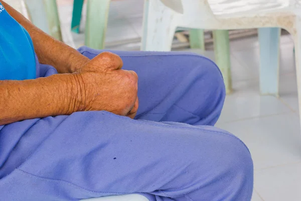 Primer plano mano de viejo asiático hombre sufriendo de lepra, amputado mano — Foto de Stock