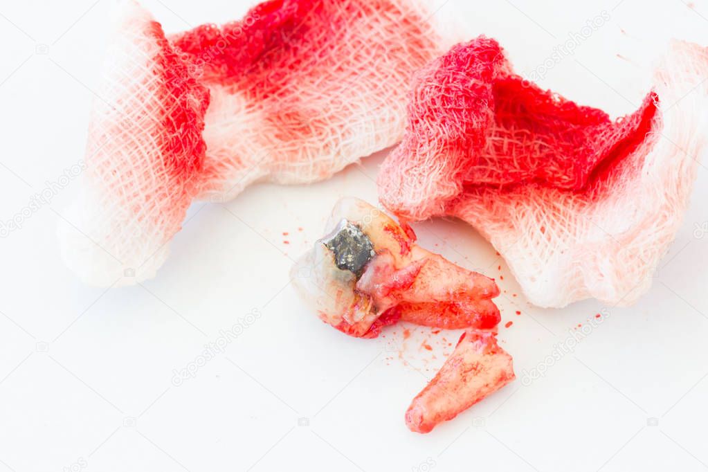Extraction of decayed tooth with bloody gauze pad on white background. health concept