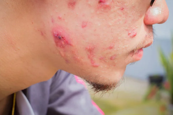 Close-up foto horizontal da bochecha masculina com grande espinha ou acne abcesso . — Fotografia de Stock