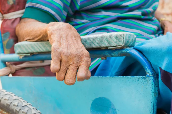 Main de gros plan du vieil homme souffrant de lèpre, main amputée, en fauteuil roulant — Photo