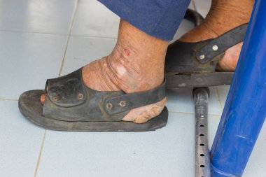 eski Asya adam cüzzam acı metrelik portre 