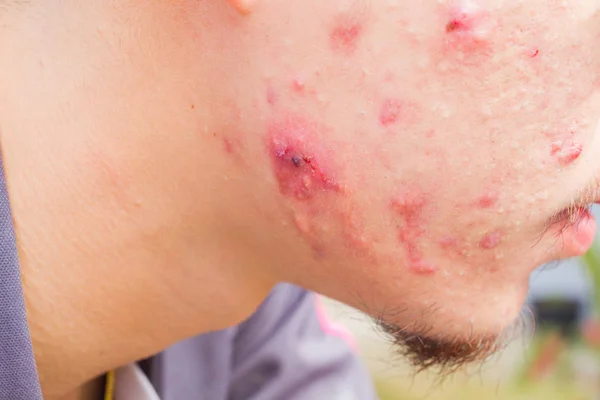 Closeup horizontal photo of male cheek with big pimple or acne abcess. — Stock Photo, Image