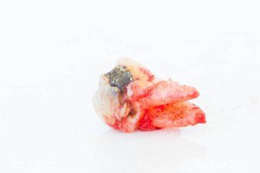 Beyaz arka plan üzerinde çürük diş çıkarma. 