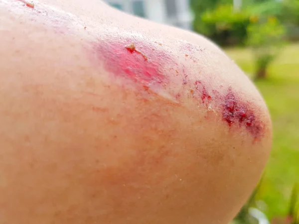 Närbild färska röda blodiga sår på armbågen — Stockfoto