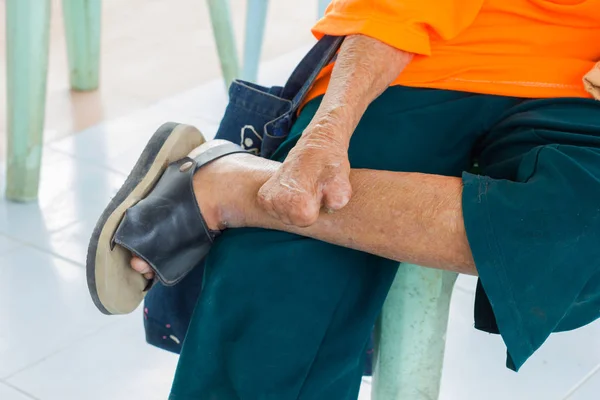 Nahaufnahme Fuß und Hand eines alten asiatischen Mannes, der an Lepra leidet — Stockfoto