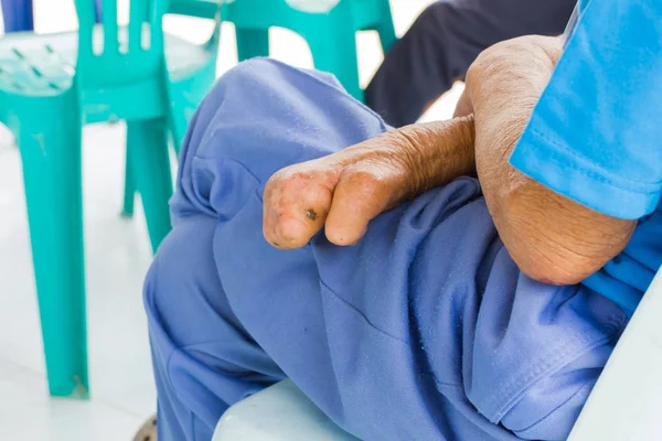 ハンセン病、切断された手に苦しむアジア老人のクローズ アップ手 — ストック写真