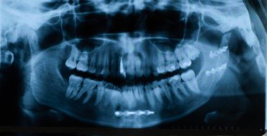 Kırık ve osteosentez sonrasında titanyum plakaların kurulumu ile çene panoramik X-ray.