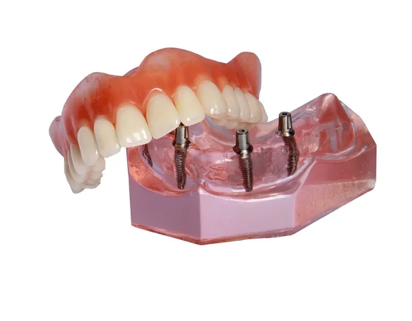 Model of a jaw and denture 2 — Stock Photo, Image